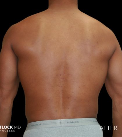 High Def Liposuction Male Before & After Patient #2737