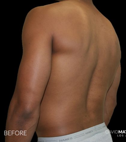 High Def Liposuction Male Before & After Patient #2737