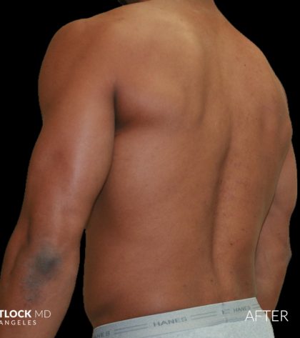 High Def Liposuction Male Before & After Patient #2737