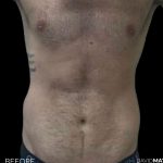 High Def Liposuction Male Before & After Patient #2728
