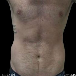High Def Liposuction Male Before & After Patient #2728