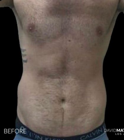 High Def Liposuction Male Before & After Patient #2728