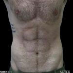 High Def Liposuction Male Before & After Patient #2728