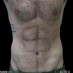 High Def Liposuction Male Before & After Patient #2728