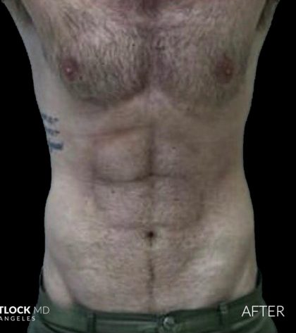 High Def Liposuction Male Before & After Patient #2728