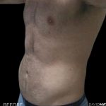 High Def Liposuction Male Before & After Patient #2728