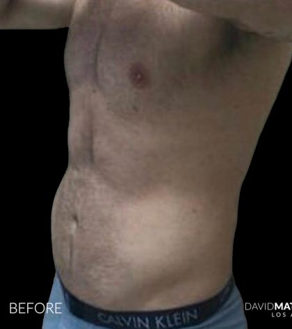 High Def Liposuction Male Before & After Patient #2728
