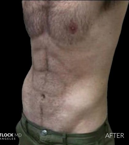 High Def Liposuction Male Before & After Patient #2728