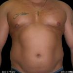 High Def Liposuction Male Before & After Patient #2729