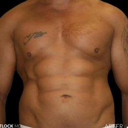 High Def Liposuction Male Before & After Patient #2729