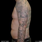 High Def Liposuction Male Before & After Patient #2730