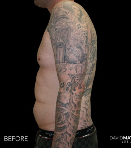 High Def Liposuction Male Before & After Patient #2730