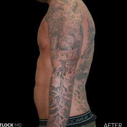 High Def Liposuction Male Before & After Patient #2730