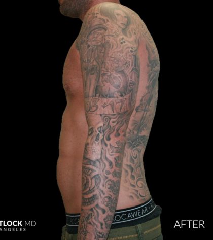 High Def Liposuction Male Before & After Patient #2730