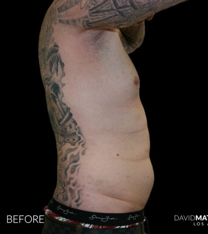 High Def Liposuction Male Before & After Patient #2730