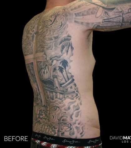 High Def Liposuction Male Before & After Patient #2730