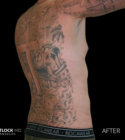 High Def Liposuction Male Before & After Patient #2730