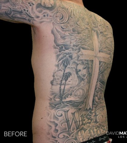 High Def Liposuction Male Before & After Patient #2730
