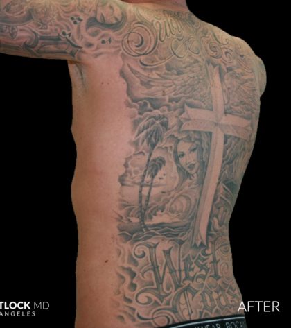 High Def Liposuction Male Before & After Patient #2730