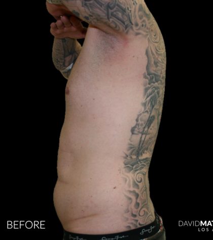 High Def Liposuction Male Before & After Patient #2730