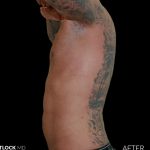 High Def Liposuction Male Before & After Patient #2730
