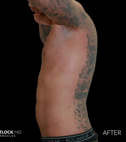 High Def Liposuction Male Before & After Patient #2730