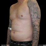 High Def Liposuction Male Before & After Patient #2730
