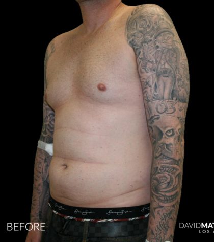 High Def Liposuction Male Before & After Patient #2730