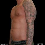 High Def Liposuction Male Before & After Patient #2730