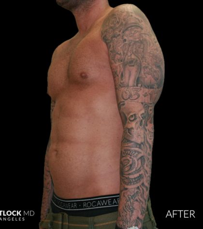 High Def Liposuction Male Before & After Patient #2730