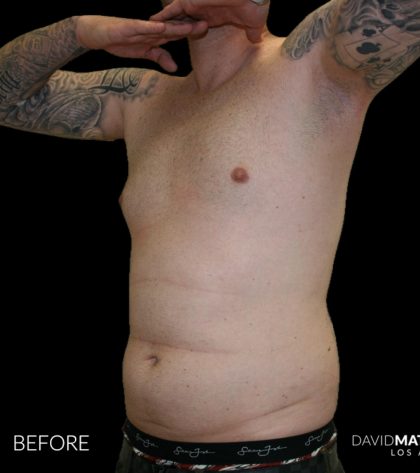 High Def Liposuction Male Before & After Patient #2730