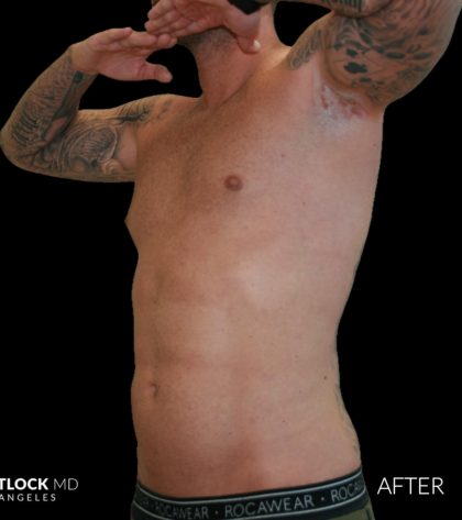 High Def Liposuction Male Before & After Patient #2730