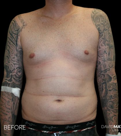 High Def Liposuction Male Before & After Patient #2730