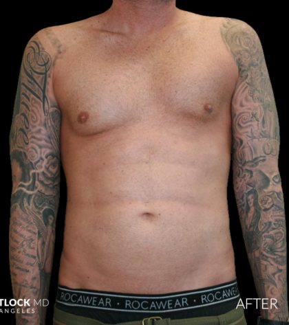 High Def Liposuction Male Before & After Patient #2730
