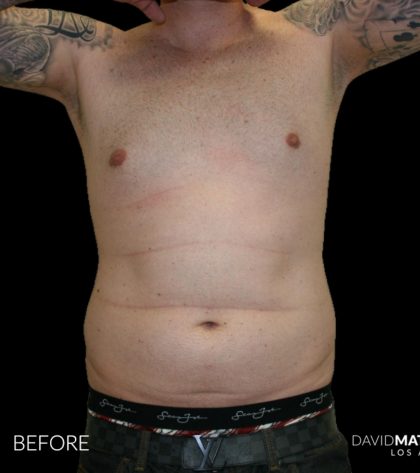 High Def Liposuction Male Before & After Patient #2730