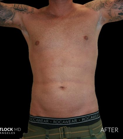 High Def Liposuction Male Before & After Patient #2730