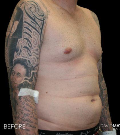 High Def Liposuction Male Before & After Patient #2730