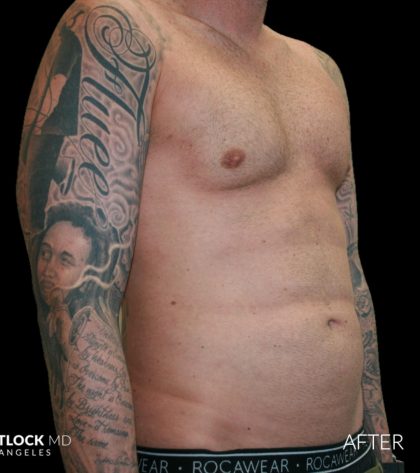 High Def Liposuction Male Before & After Patient #2730