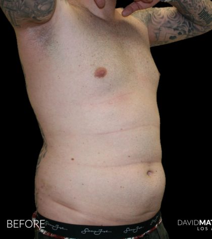 High Def Liposuction Male Before & After Patient #2730