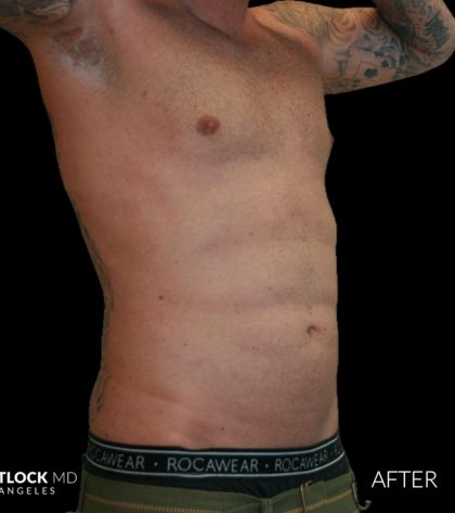 High Def Liposuction Male Before & After Patient #2730