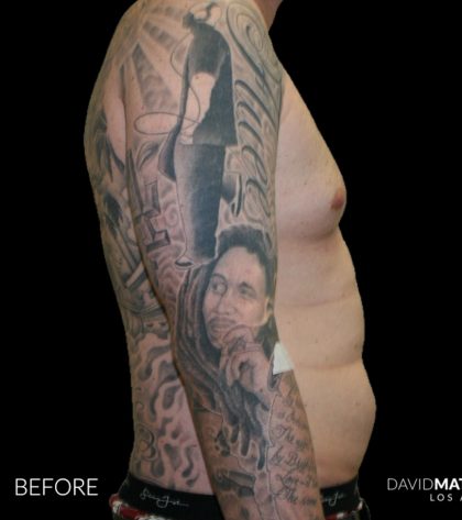 High Def Liposuction Male Before & After Patient #2730