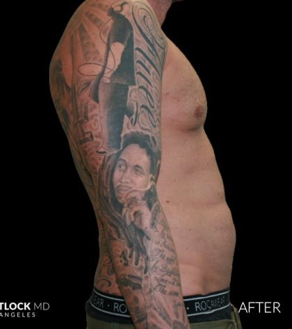 High Def Liposuction Male Before & After Patient #2730