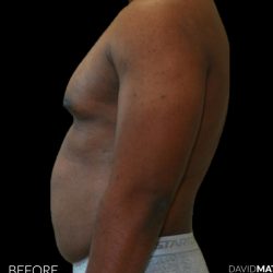 High Def Liposuction Male Before & After Patient #2731