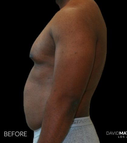High Def Liposuction Male Before & After Patient #2731