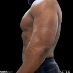 High Def Liposuction Male Before & After Patient #2731