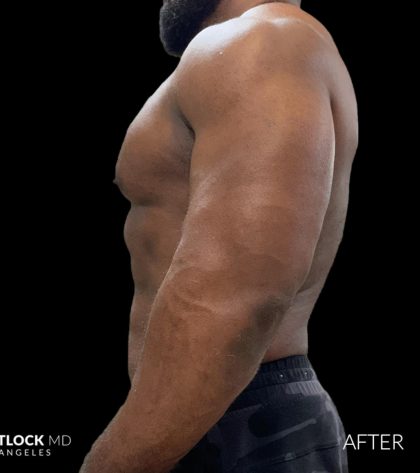 High Def Liposuction Male Before & After Patient #2731