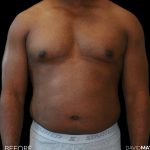 High Def Liposuction Male Before & After Patient #2731