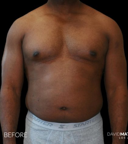 High Def Liposuction Male Before & After Patient #2731