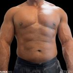 High Def Liposuction Male Before & After Patient #2731