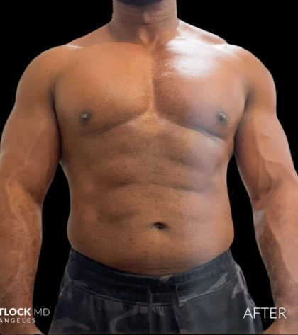 High Def Liposuction Male Before & After Patient #2731